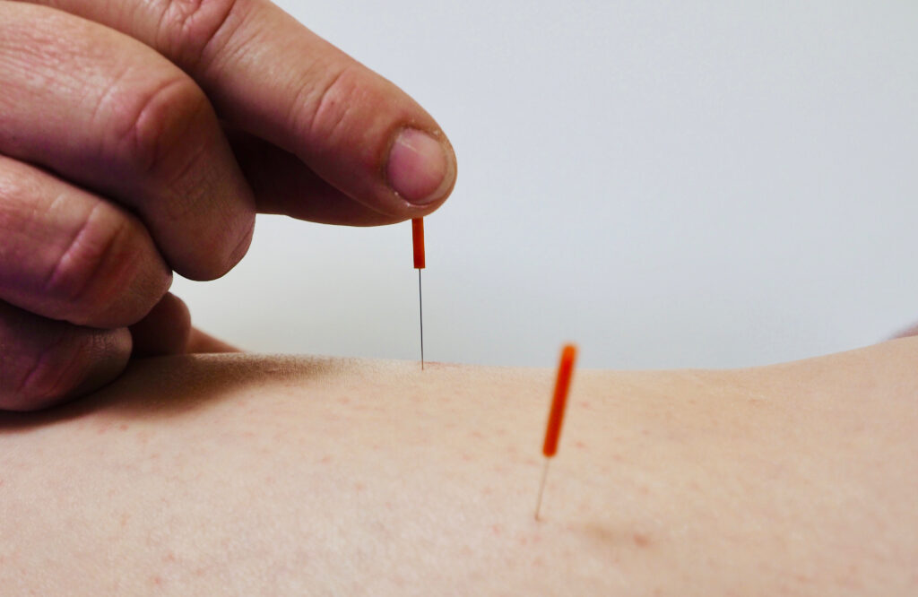 Akupunkturnadeln, die in Haut stecken.